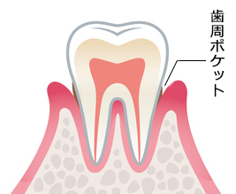歯周病の診査、診断のご説明