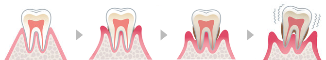 歯周病の進行過程