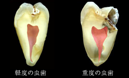 ミニマルインターベーション虫歯治療