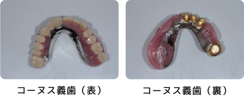 コーヌスクローネ義歯